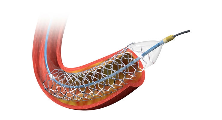Coronary Stent Market Promising and High-growth Technology Opportunities for Forecast, 2030