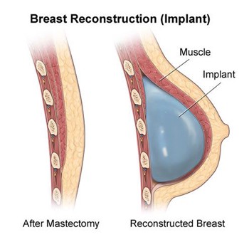 Should You Opt for Breast Reconstruction After Mastectomy?