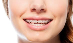 which is the best dental clinic for braces in Hyderabad