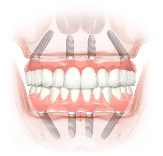 Dental Implant Procedure | Center for Implant Dentistry | Fremont CA