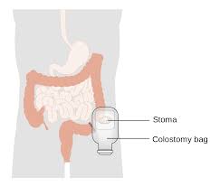 Ostomy/Stoma Care Market Size & Share to Boom at Double-Digit CAGR During Forecast Year 2022-2030