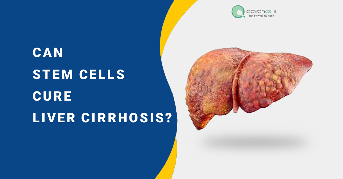 Can Stem Cells Cure Liver Cirrhosis?
