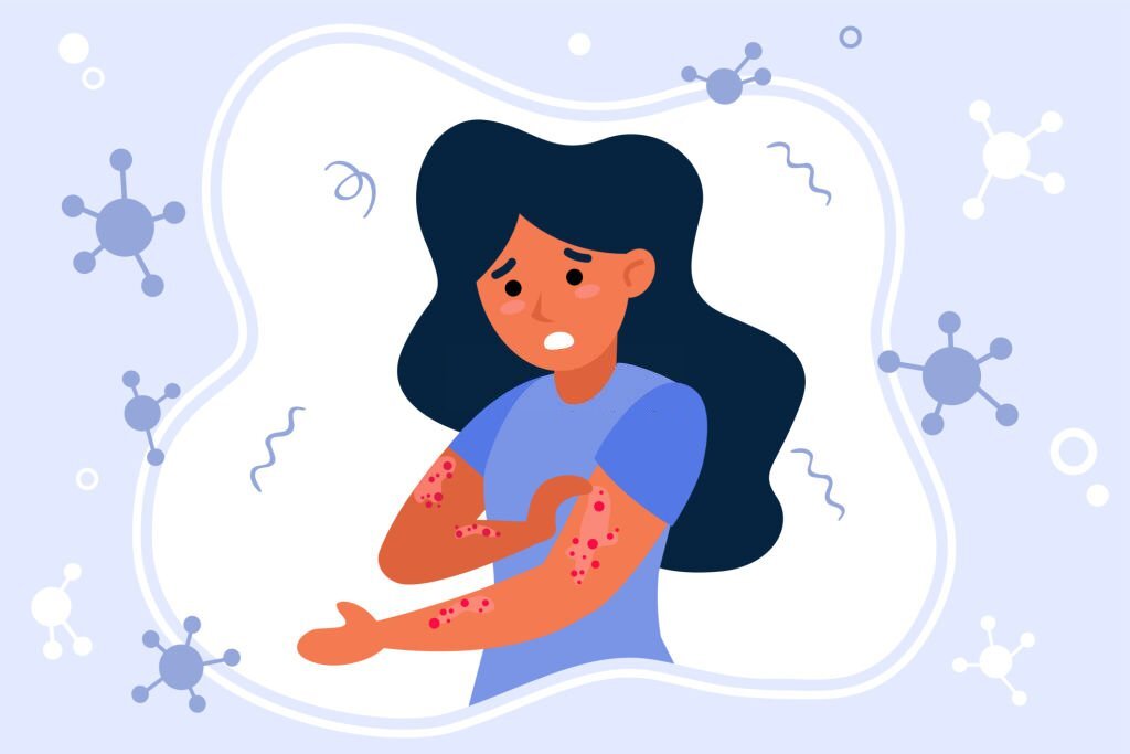 Psoriasis isn’t Contagious, But Awareness Should Always Come First