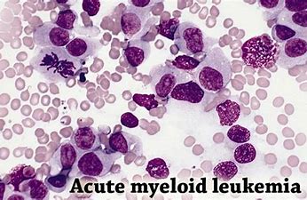 Global Acute Myeloid Leukemia Market Highlights, Overview and Forecasts to 2031