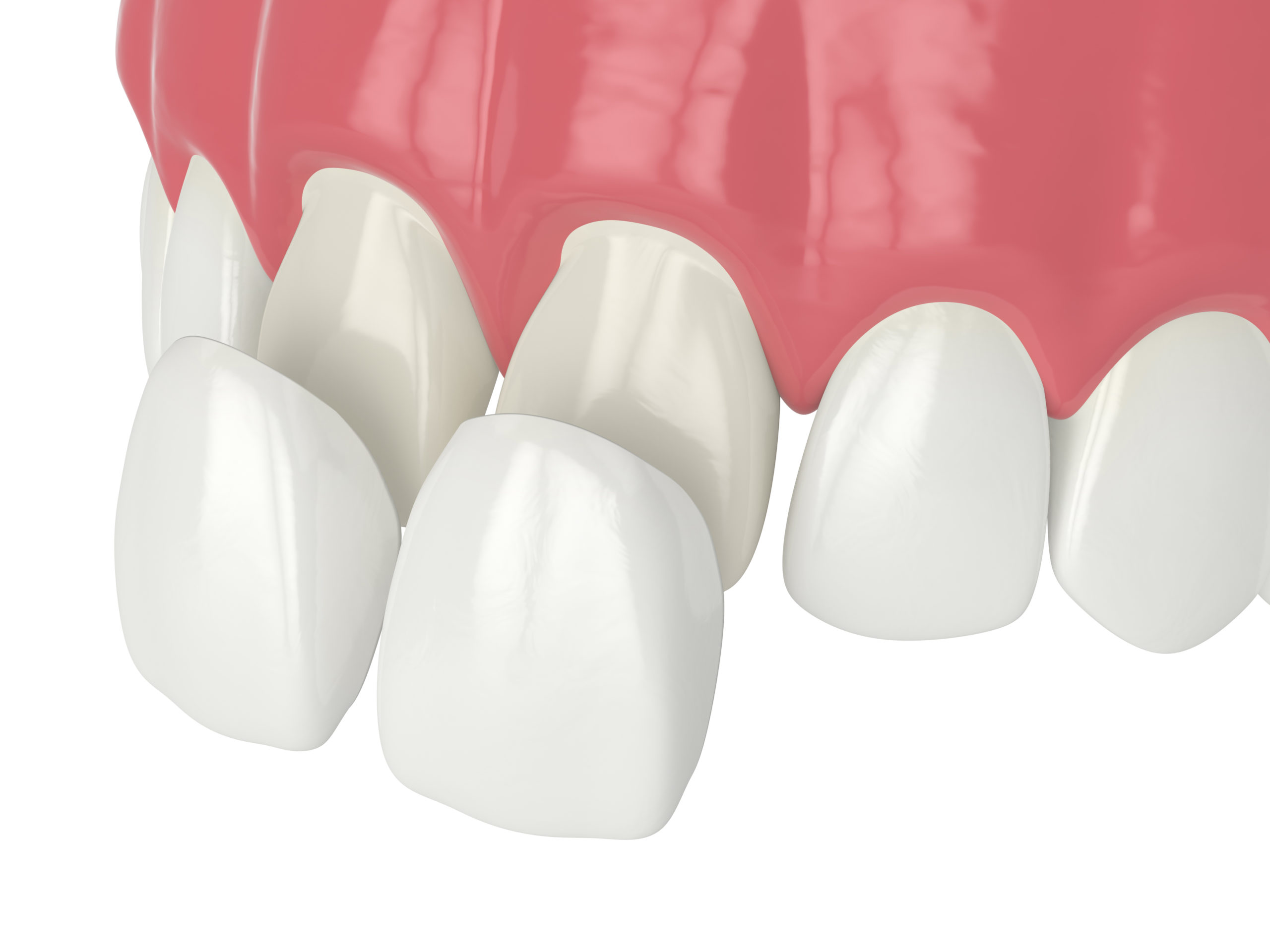 What are Dental Veneers?