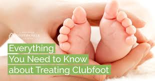 Ponseti Method for Clubfoot