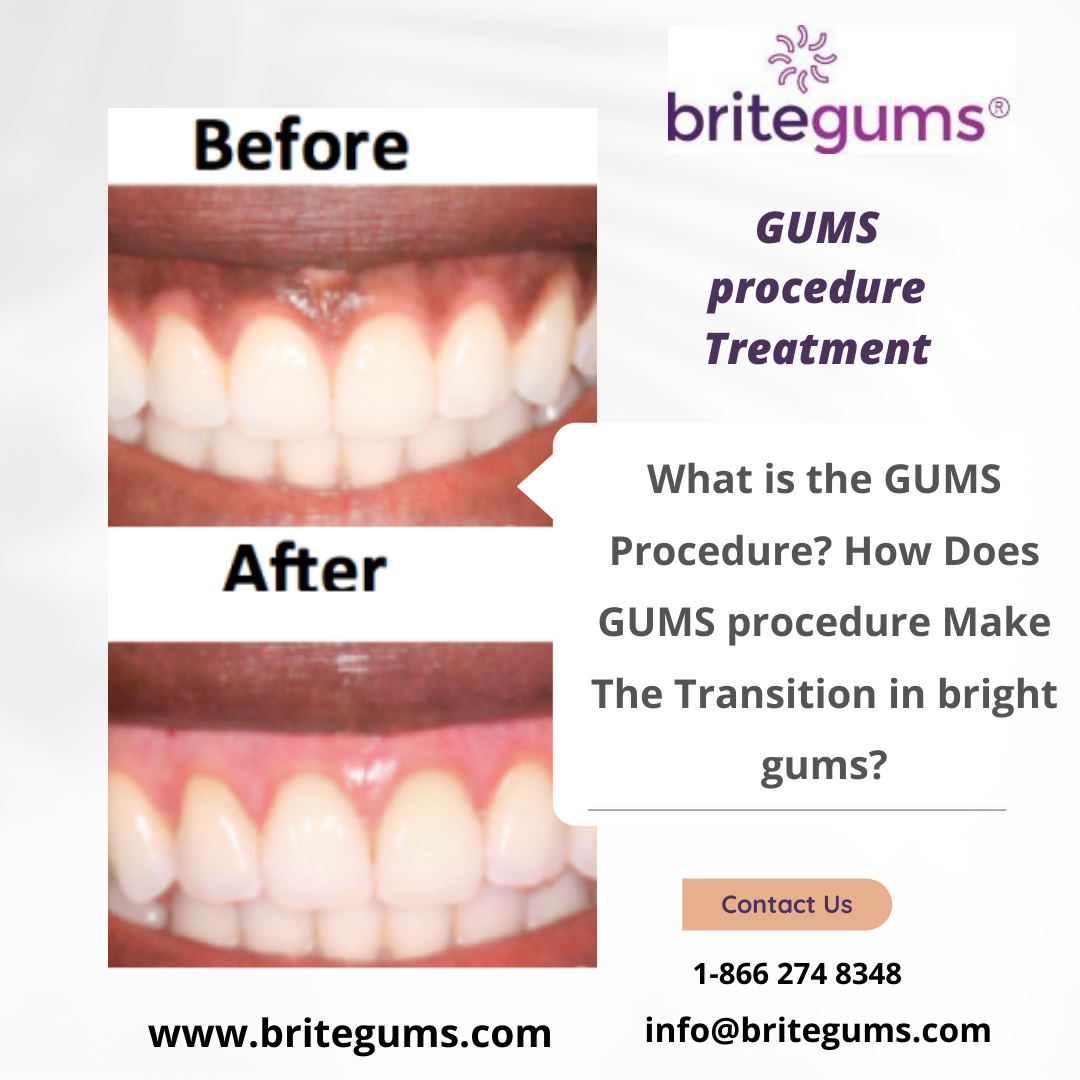 What is the GUMS Procedure? How Does GUMS procedure Make The Transition in bright gums?