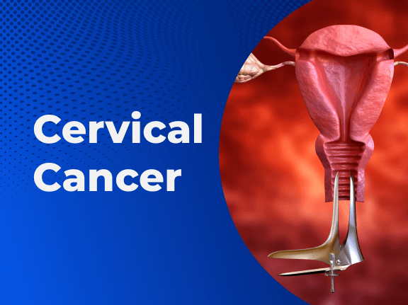 Cervical Cancer Treatment Market Size, Dynamics & Forecast Report to 2030