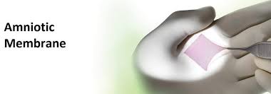 Amniotic Membrane Market 2022 Top key Players and Analysis Report Till 2028