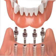 Denture Market Key Players, Share & Forecast Report to 2028