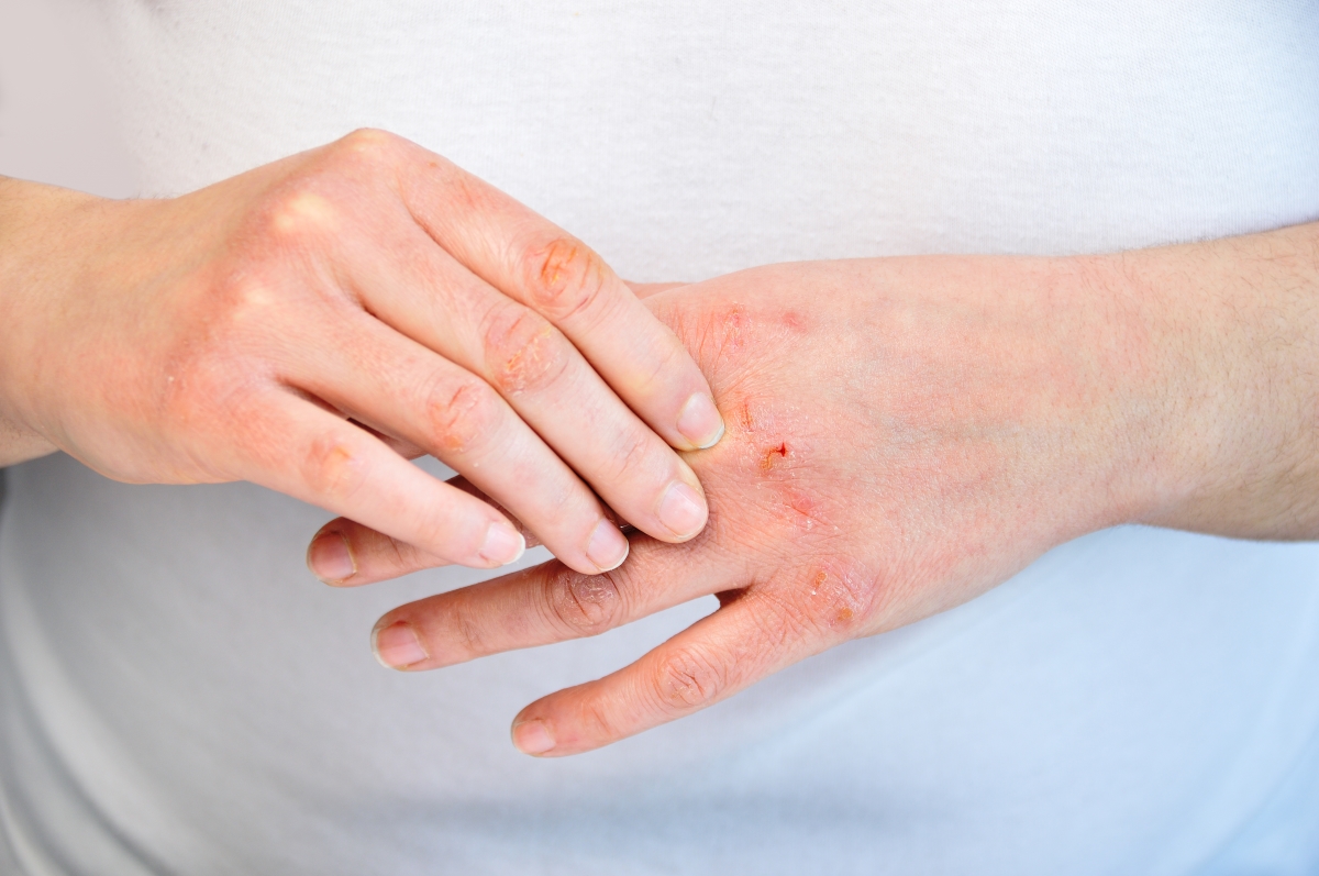Contact Dermatitis Market share | Industry Analysis By Top Key Players, Demand, Growth factors to 2028