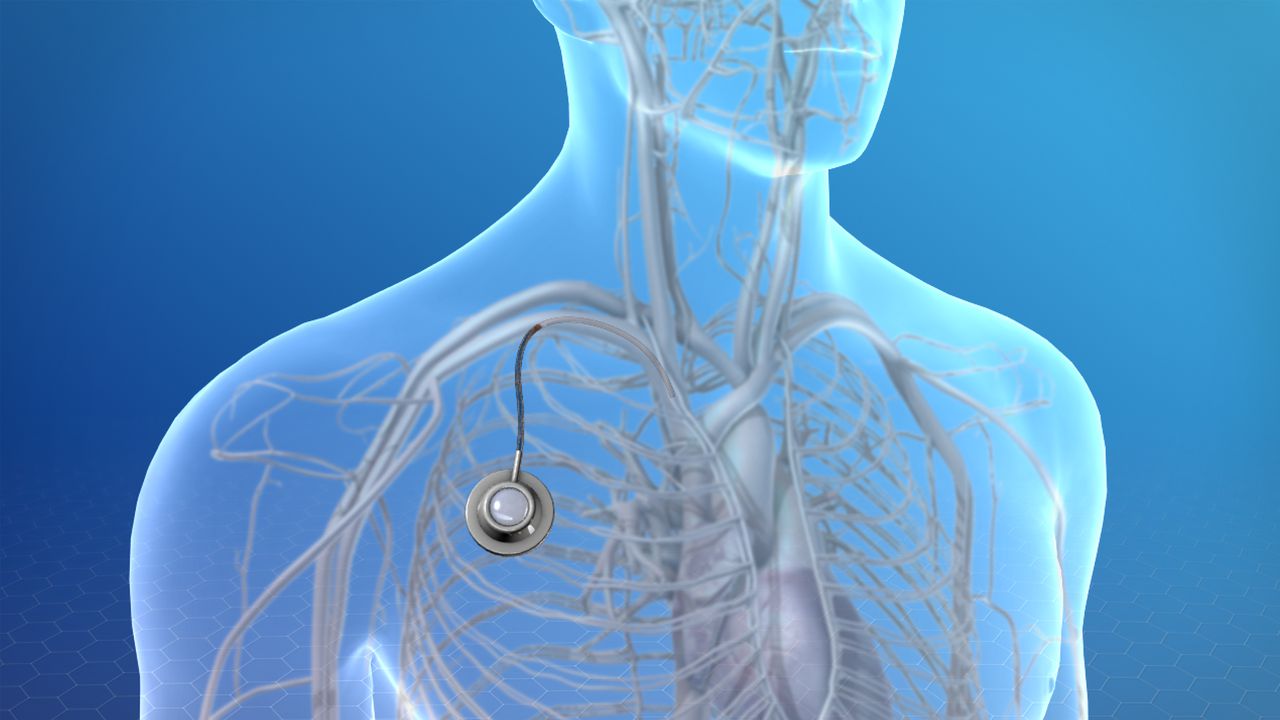 Totally Implantable Access Port Market Share, Revenue and Growth Analysis Report Till 2028 | Value Market Research
