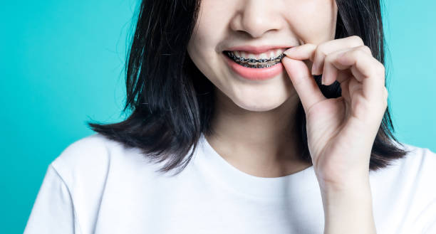 Metal Braces Vs. Clear Braces: Which Is Right For You?