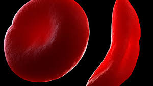 Sickle Cell Anemia Market 2022 Top key Players and Analysis Report Till 2028