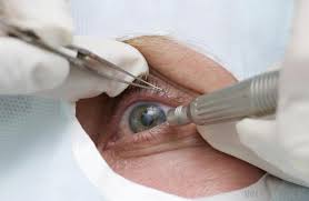 Cataract Surgery Devices Market 2022 Growth, Share & Forecast Report to 2028