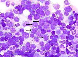 T-Cell Acute Lymphoblastic Leukemia Market Latest Trends and Outlook Report 2028