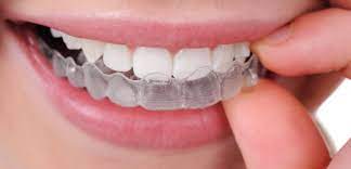 All You Need to Understand About Invisalign  
