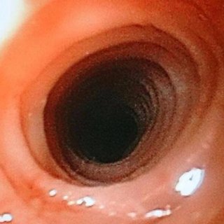 Biologics Is Fastest Growing Segment Fueling The Growth Of Eosinophilic Esophagitis Market
