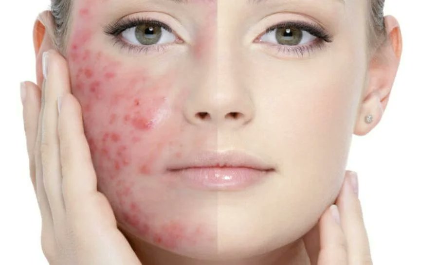 Herbal Remedies for Acne Vulgaris Treatment: A Review of Efficacy and Safety