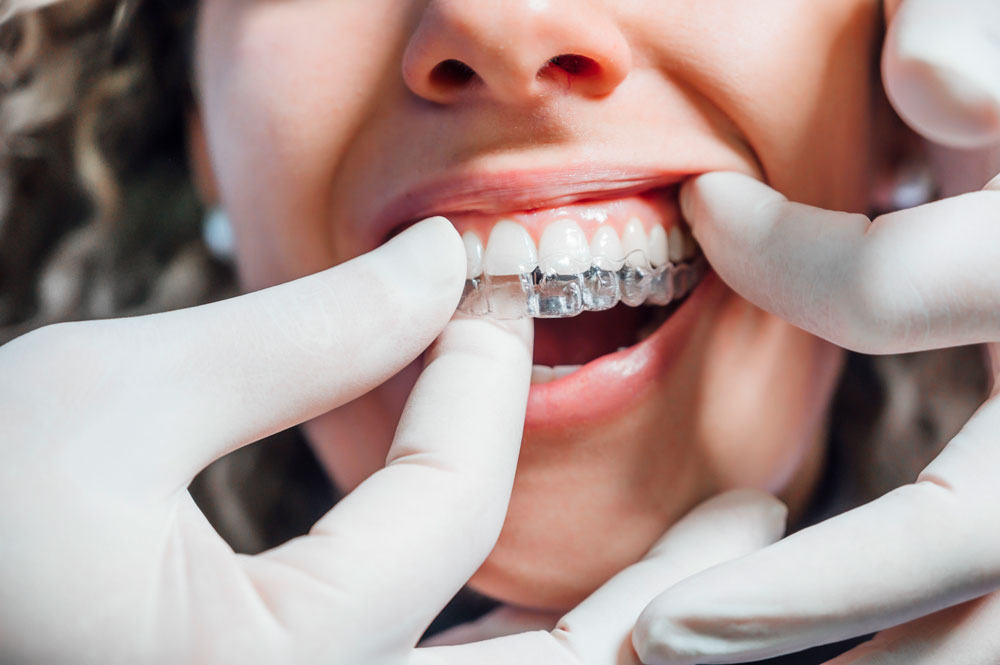 What is Invisalign(invisible) Orthodontics?