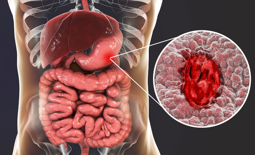 Exploring the Connection: Can Gallbladder Surgery Cause Gastroparesis?