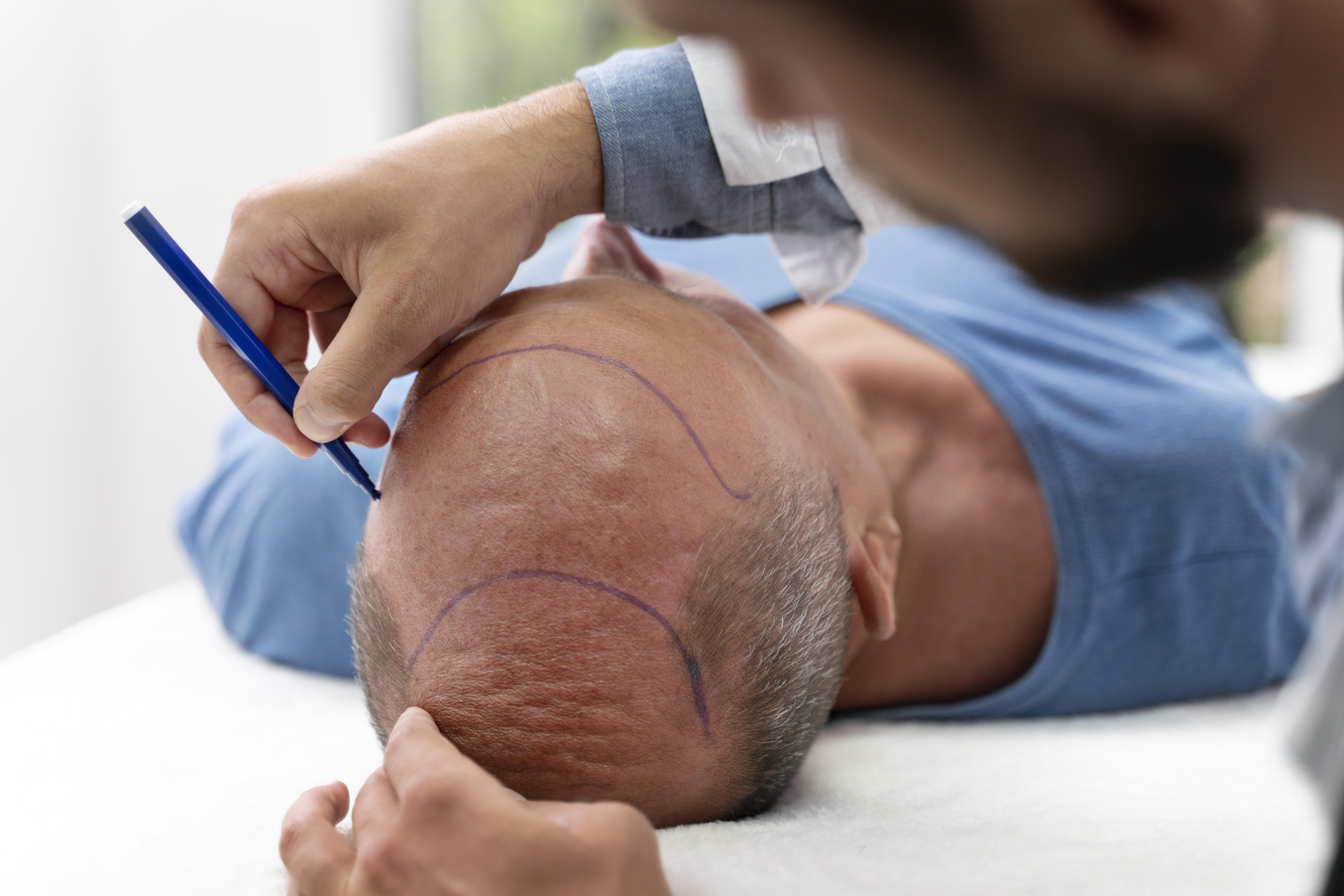 Modern Technique Use for Hair Fall Treatment In Patna, Bihar