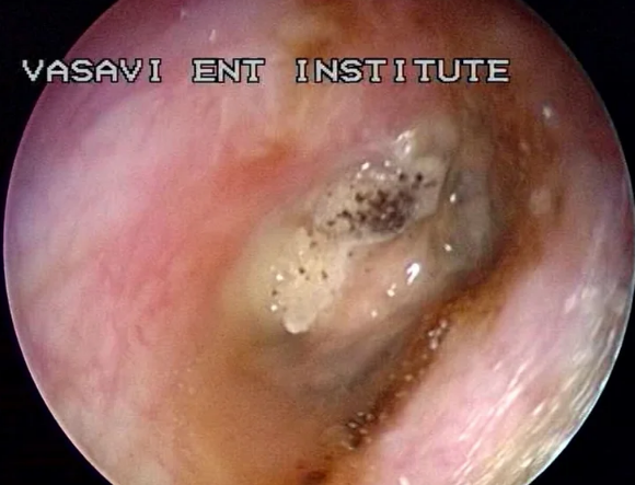 Unveiling The Intricacies Of Fungal Ear Infection: A Comprehensive Exploration