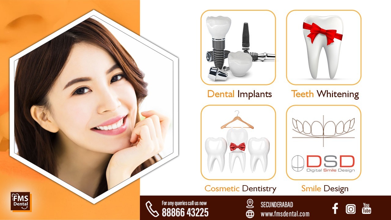 Hollywood Smile Design