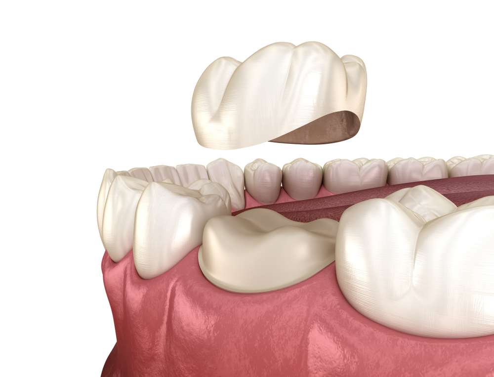 What's the difference between Dental Caps and Dental crown service Toronto Service?