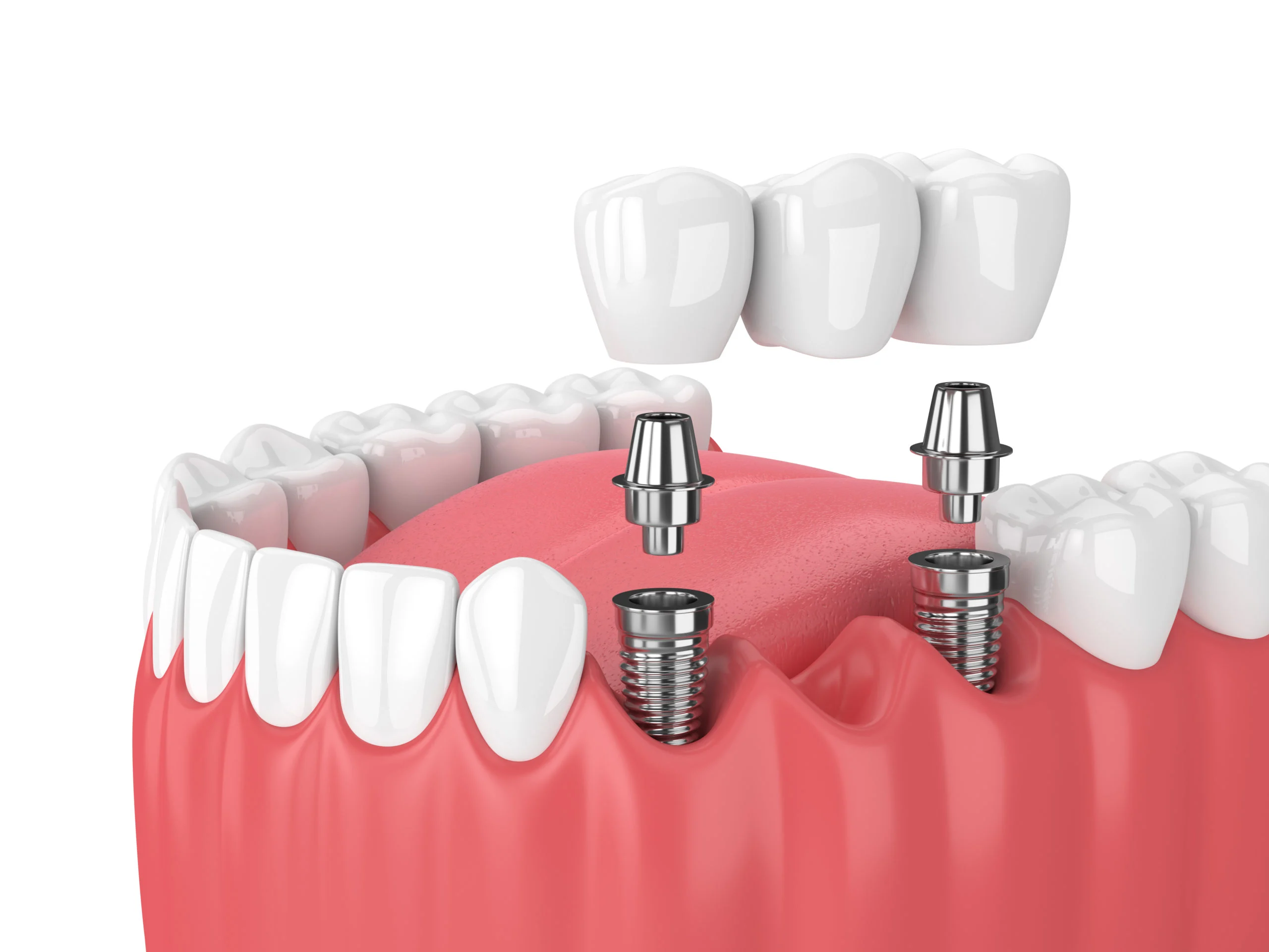 Restore Your Gapped or Lost Teeth with Dental Bridges Services