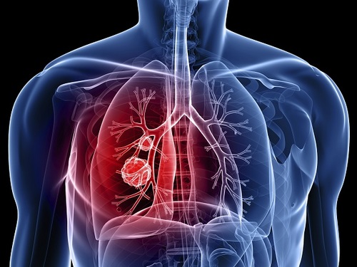 Lung Cancer Diagnostic Tests Market Size, In-depth Analysis Report and Global Forecast to 2028