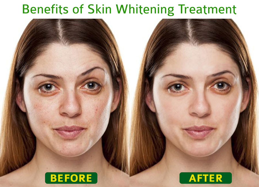What are the skin whitening treatments benefits?