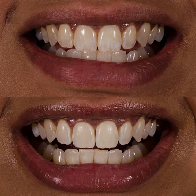 BEST DENTAL TEETH WHITENING MISSISSAUGA, ON