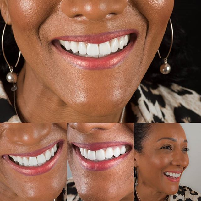 BEST DENTAL TEETH WHITENING MISSISSAUGA, ON