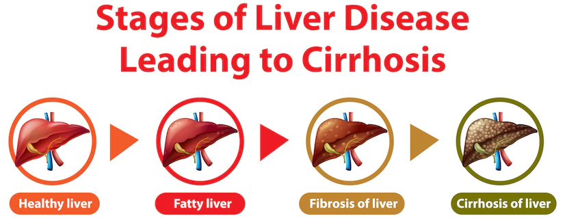 Causes, symptoms, and treatment of fatty liver disease
