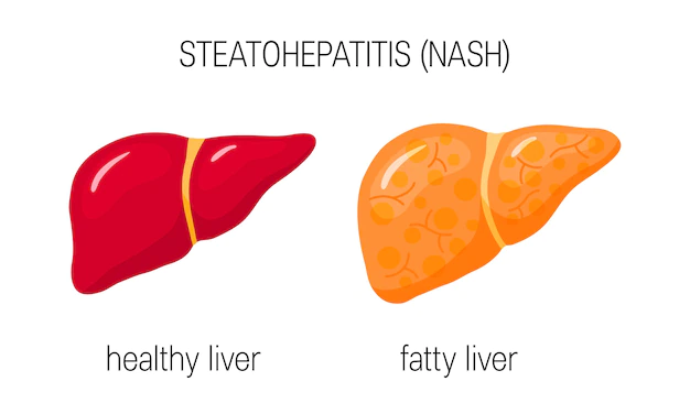 Fatty Liver Disease: Top 7 Foods you must include in your diet