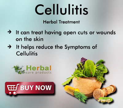 Natural Remedies for Cellulitis Herbal Treatment