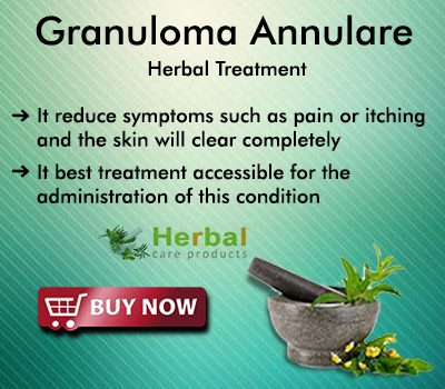 Herbal Treatment for Granuloma Annulare | Remedies | Herbal Care Products
