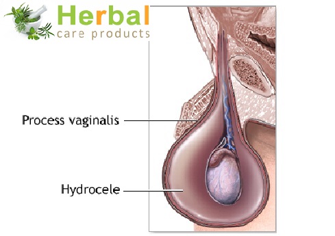 Hydrocele Symptoms, Causes, Diagnosed And Treatment