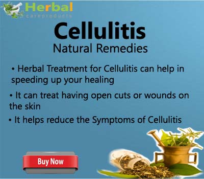 Herbal Treatment for Cellulitis - Herbal Care Products