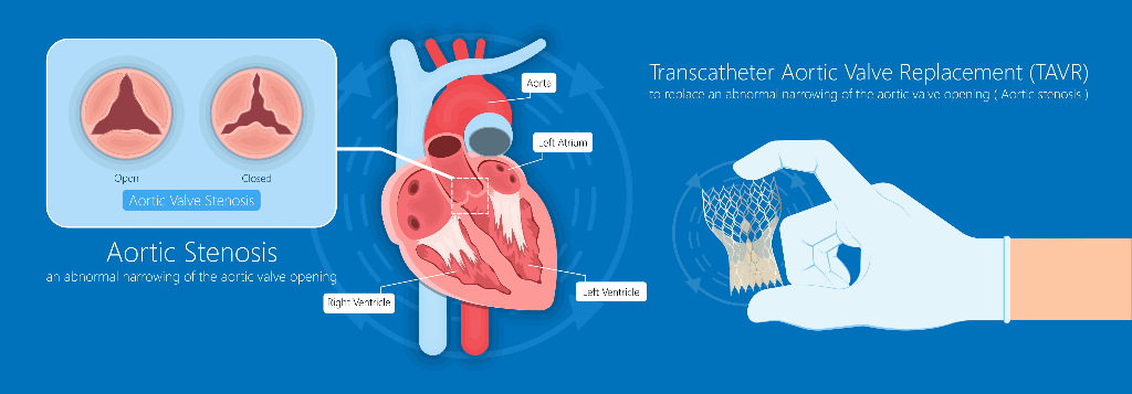 All you want to know about Transcatheter Aortic Valve replacement(TAVR)