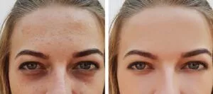 What Are The Proven Techniques to Reduce Thigh Fat And Dark Circles?