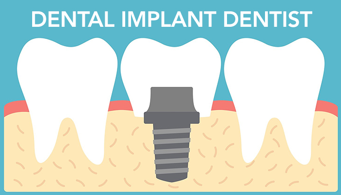 Dental Implants | Deluxe Dental Kuna, ID