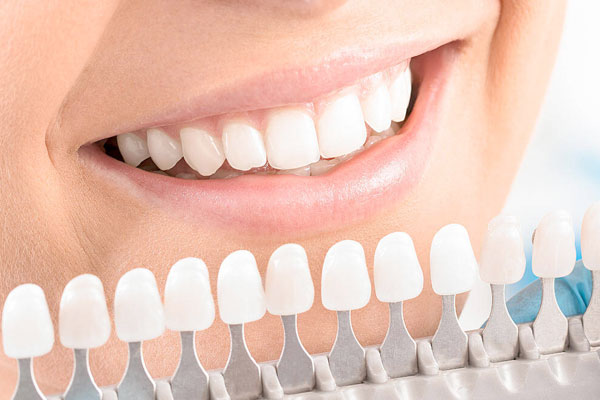 Porcelain Veneers | Kuna, ID | Deluxe Dental Group