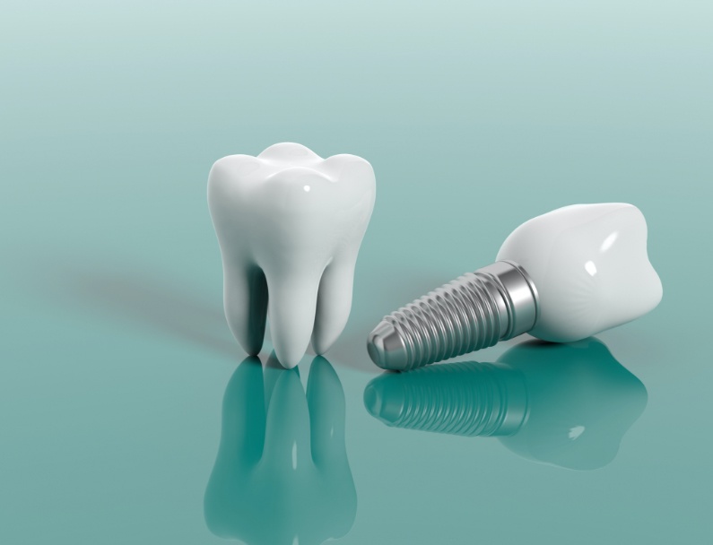 Are Dental Implants Suitable for Everyone?