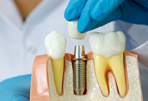 Why Are Dental Implants So Important?