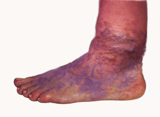 sclerotherapy treatment clinic