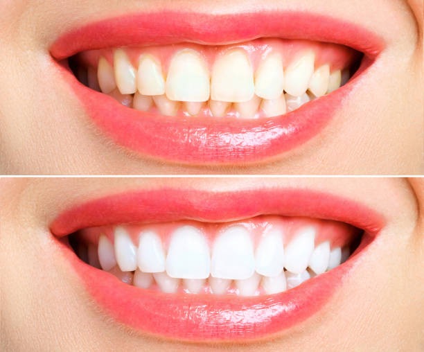 Teeth whitening myths that you should never believe                