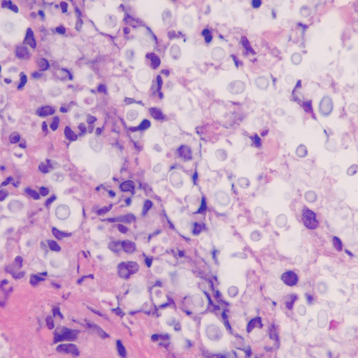 Understanding Cryptococcosis Treatment: Effective Medications and Therapies