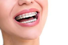  Superb Orthodontic Treatment for Families and Military Personnel in Fort Walton Beach